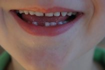 “Klima mi se zub”: Kada ispadaju prvi mlečni zubi i šta očekivati?